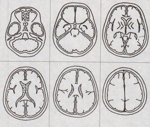 転移性脳腫瘍に対するガンマナイフ治療 脳MRI