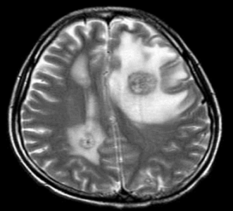 ガンマナイフ後   脳浮腫合併例（図４）