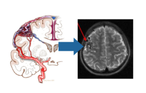脳動静脈奇形に対するガンマナイフ治療